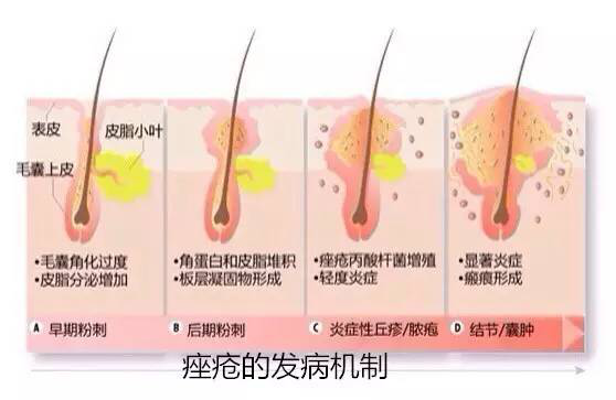 痤疮的发病机制